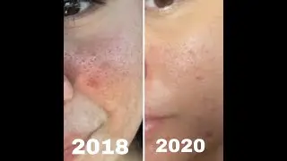 VENUS VIVA RESURFACING MICRONEEDLE TREATMENT #2