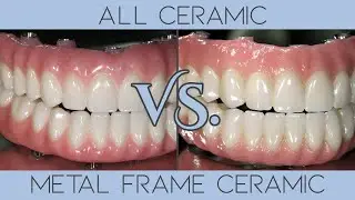 All Ceramic Dentures VS Metal Frame With Ceramic Exterior