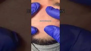 Dehydrated skin vs Hydrated skin at Wise Med Spa in Wayne, NJ keep your skin glowing all winter long