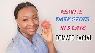 REMOVE DARK SPOT NATURALLY | ACNE SCARS | TEMIBLOGTV