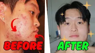 My Acne Transformation | From Severe Acne to Clear Skin