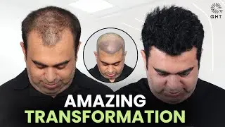 Diffuse Grade 3A Hair Transplant | Grade 3 Hair Transplant | Grade 3 Hairloss | Grade 3 | QHT Clinic