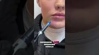 How to get balanced results using DAO (Depressor Anguli Oris) correction techniques.