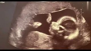Anomaly Scan Full Video | Full Anatomy Scan at 21 Weeks