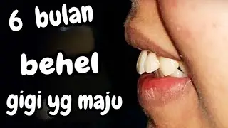 6 bulan perawatan behel gigi maju, dokter gigi Jogja menjelaskan