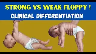 Floppy Infant Explained: Strong vs Weak Floppy