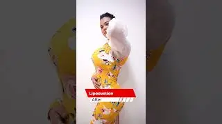 Liposuction result | Liposuction Feedback 360 Abdominal Liposuction #short #Short #shortvideo #share
