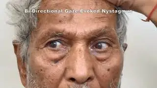 Acute Vestibular Syndrome