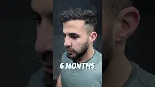 HAIR TRANSPLANT BEFORE AFTER - 9 MONTHS - SMILE HAIR CLINIC
