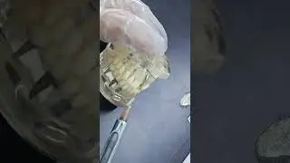 infiltration anesthesia technique| تقنية التخدير الموضعي
