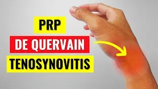 The Truth About PRP Injections for De Quervain's Tenosynovitis