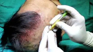 biofibre implantation video cut after 33 sec