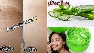 Using Aloe Vera Gel On My Stretch Marks Actually Did For Me - You Won't Believe What Happened After😱