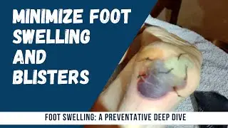 Foot Swelling: A Preventative Deep Dive