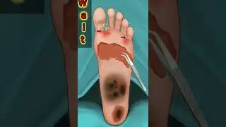 asmr removal fungal infection animation #asmr #yt shots #shortsvideo