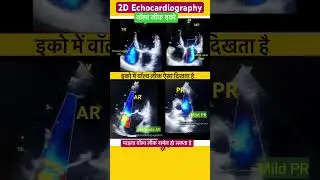 हार्ट वाल्व लीक इको l Valve Regurgitation Echo #echo #heart #shorts