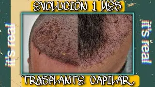 #16.-Evolución TRASPLANTE CAPILAR 1 MES