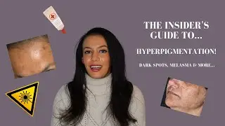 Doctor's Guide To Hyperpigmentation Treatment: Causes & How To Treat Melasma,  Dark Spots & More!