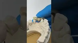 3-Unit Posterior Bridge #lsk121shorts #dental #teeth