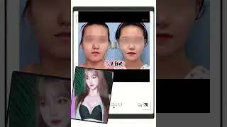 V line surgery at THE PLASTIC SURGERY
