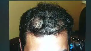 Hairline Repair After a Bad Transplant | Natural Result by Dr. Diep