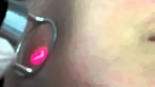 Dr. Carniol Fractional CO2 Laser