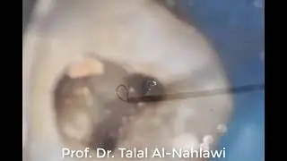 broken file removal with btr pen loop Prof Dr Talal Al-Nahlawi د. طلال النحلاوي