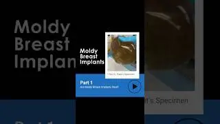 Are moldy breast implants real? #breastimplantillness  #plasticsurgery