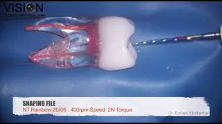 NT RAINBOW S Rotary File- Dr Roheet Khatavkar Demonstration