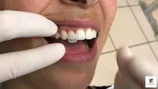 Dr  Newton Fahl uses Uveneer Composite Veneer System