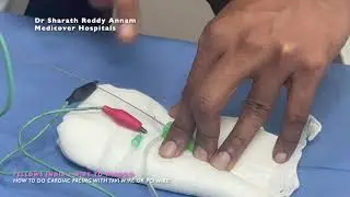 HOW TO DO CARDIAC PACING WITH TAVI WIRE OR PCI WIRE - Live Bailout Technique