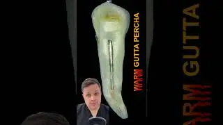 WARM VERTICAL COMPACTION | HOW TO #rootcanals #rootcanaltreatment  #obturation #guttapercha