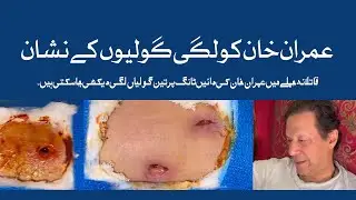 Imran Khan injury wounds video | Imran Khan Kay Zakhmon Ki Video