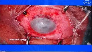 AIOC2024  IC37 Topic  Dr Mudit Tyagi Indications for endoscopic vitrectomy in uveitis