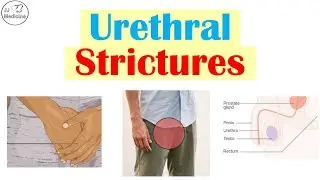 Urethral Strictures: Causes, Symptoms and Complications, Diagnosis, Treatment