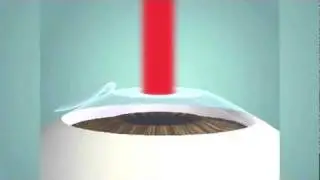 LASIK (Microkeratome)