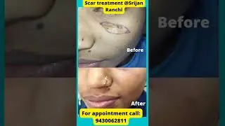 Scar treatment in Ranchi| Review of Scar treatment after 2 Months| #scar #scartreatment