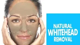 Whitehead Removal By Using Soap and Salt Mix | DIY