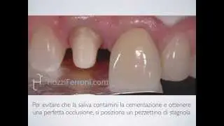 Ecco perchè cementare una corona non è attaccare un dente