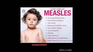 #measles #symptoms #pediatric #nurse #nhm #nclex #univercity