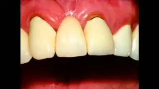 Porcelain Bridges in Cosmetic Dentistry | Lake Merritt Dental, Oakland, CA