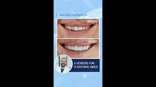 Before ➡️ After: 6 veneers transformed this smile