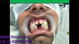 Best Dentist & Dental Bridge, fixed teeth, Ludhiana Punjab India, Jalandhar, dentist Chandigarh