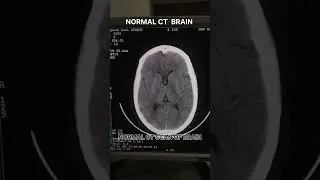ct brain #normal brain #CT SCAN #short video #viral #trending