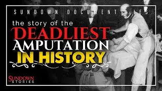 The Deadliest Amputation in History &ndash; A Surgery Gone Horribly Wrong