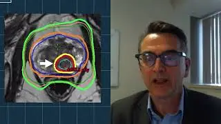 PSMA PET Prostate Cancer Radiation Therapy - Series Teaser