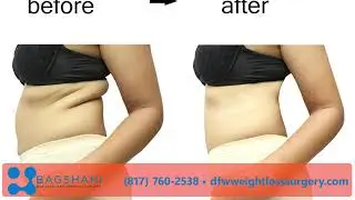 Bagshahi Bariatric and General Surgery | Diet Centers in Fort Worth