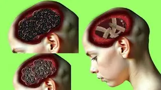 Extreme Brain Worm Infestation ASMR | Deep Parasite Removal Animation #asmranimation #animation