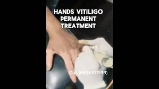 HOW TO HIDE VITILIGO PATCHES | COLOUR CORRECTOR FOR WHITE PATCHES | VITILIGO PERMANENT MAKEOVER.