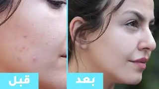 روتيني لاتخلص من حب الشباب: تنظيف، تقشير البشرة، توحيد اللون.. | مع جويل
